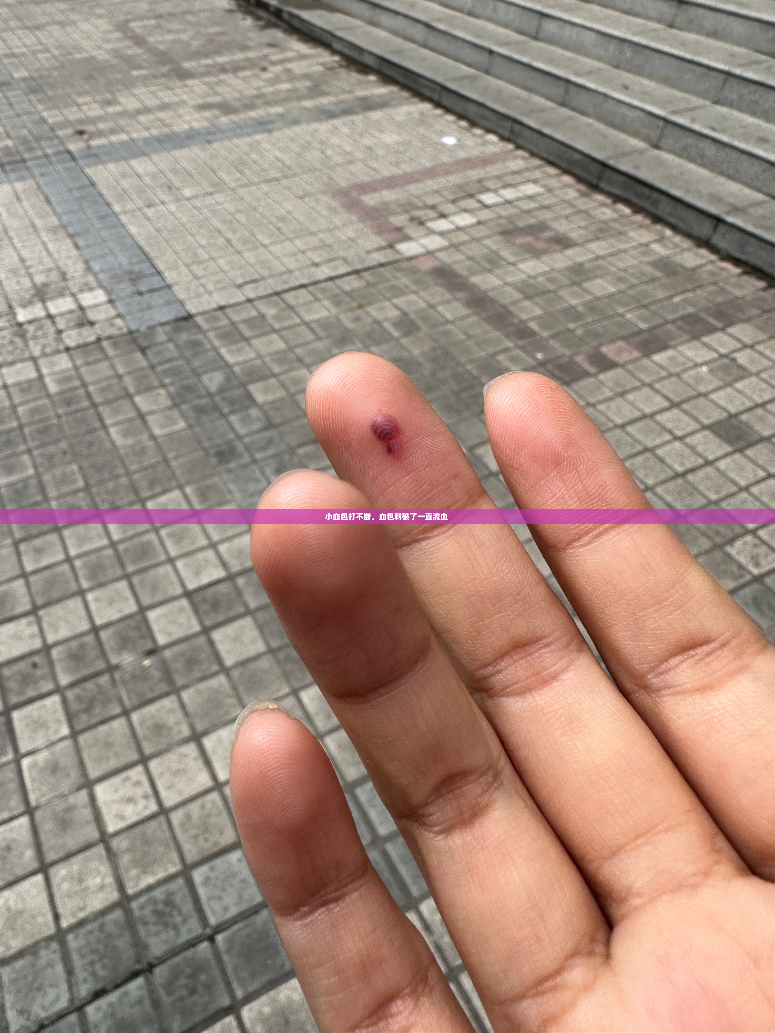 小血包打不断，血包刺破了一直流血 